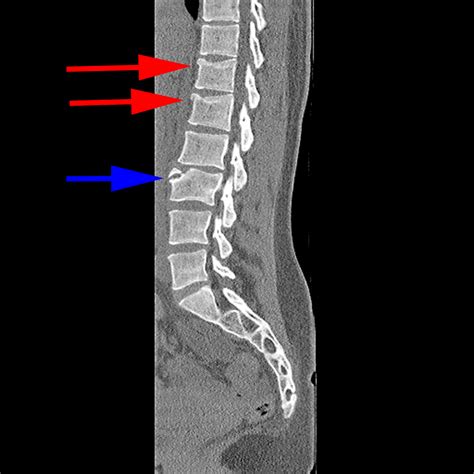 limbus bone vs fracture.